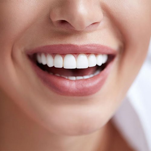 Blanchiment dentaire sans peroxyde (esthetique) ou avec peroxyde (médical)